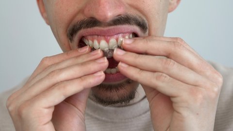 Caucasian young man adjusting and placing an invisible silicone aligner for dental correction. Male hand holding the plastic braces dentistry retainers to straighten teeth