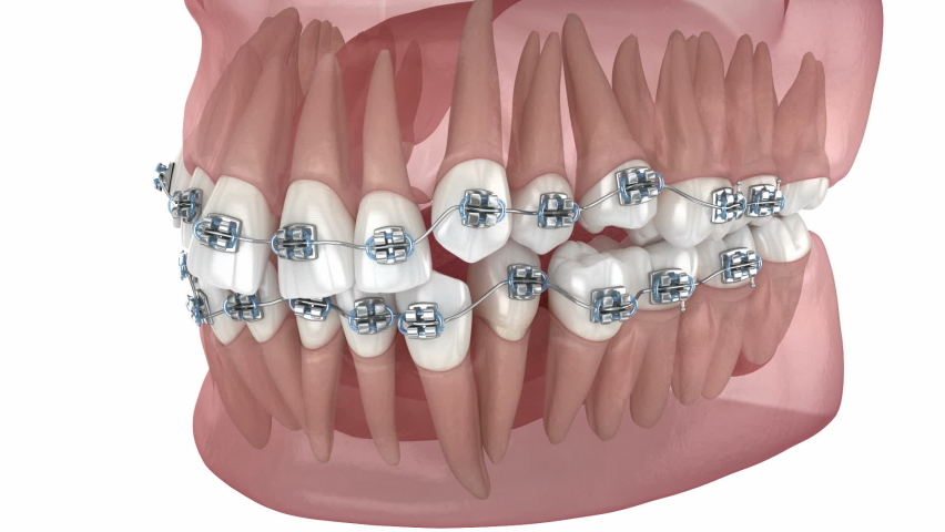 Abnormal teeth position and correction with metal braces tretament. Medically accurate dental 3D animation | Shutterstock HD Video #1087751507