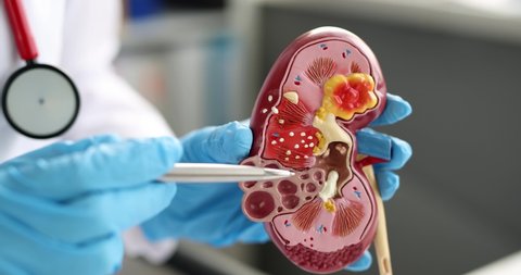 Nephrologist or urologist shows mockup of human kidney