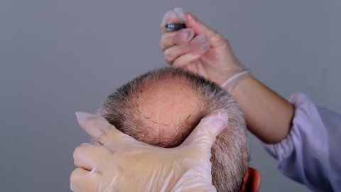 close-up trichologist treats patient, bald mature man with alopecia in hair growth clinic, anti-aging treatments for balding men. concept of hair transplant procedures for men, selective focus	