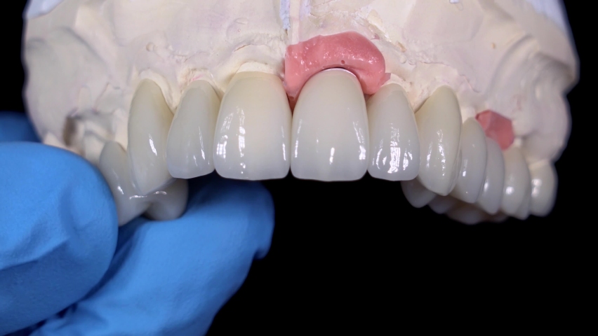 Fitting dental ceramic crowns on a model of the upper jaw from plaster on a black background | Shutterstock HD Video #1088053959