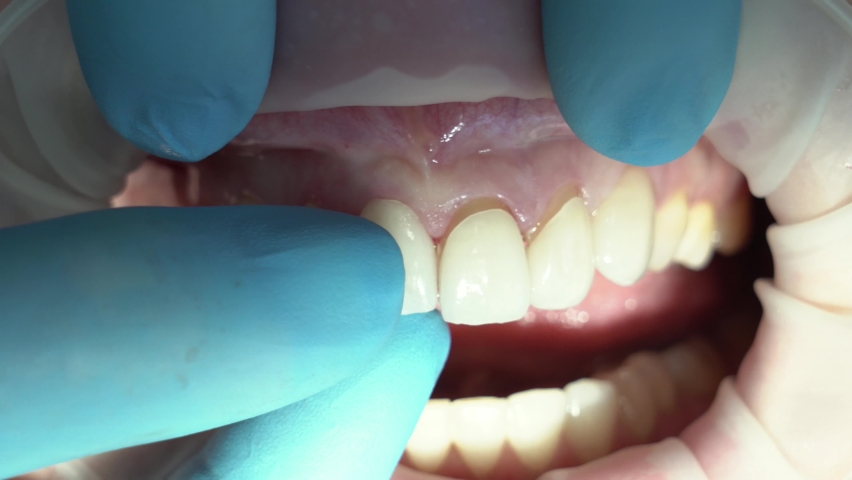 fitting of ceramic veneers on the teeth of the upper jaw Royalty-Free Stock Footage #1088064053