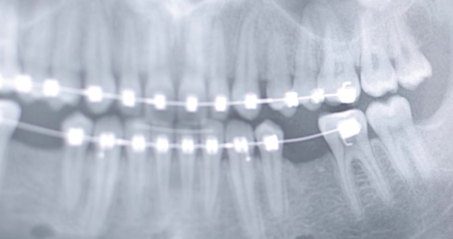X-ray picture of braces of the human jaw, skeleton, bite teeth, dentistry, orthodontics, braces on the teeth, black-and-white image, dentist, the process of making a plate for teeth. close-up Royalty-Free Stock Footage #1088310381