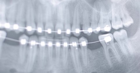X-ray image of the human jaw, skeleton, bite teeth, dentistry, orthodontics, braces on the teeth, black-and-white image, dentist, the process of making a plate for teeth, product photography, close-up