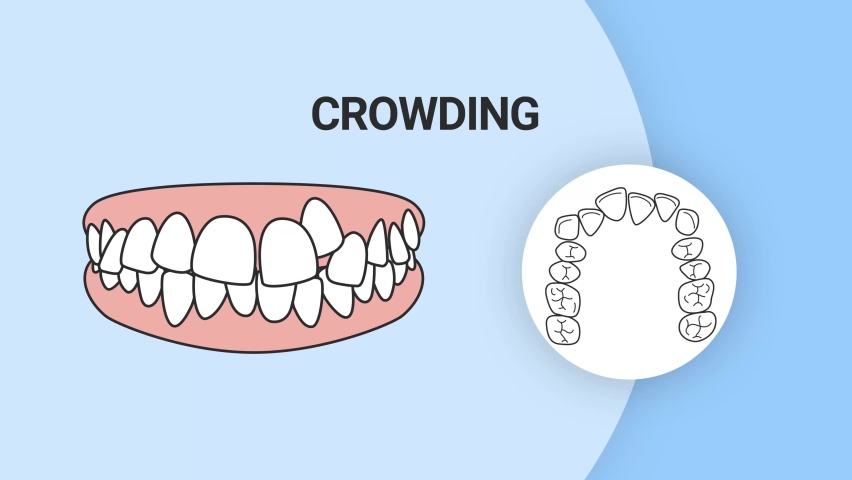 Malocclusion Crowding. Dental problem. 3d illustration. Dental care concept. | Shutterstock HD Video #1088332511