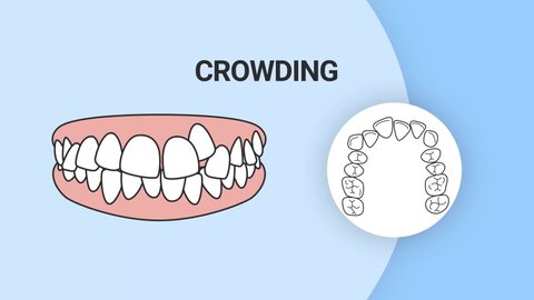 Malocclusion Crowding. Dental problem. 3d illustration. Dental care concept.