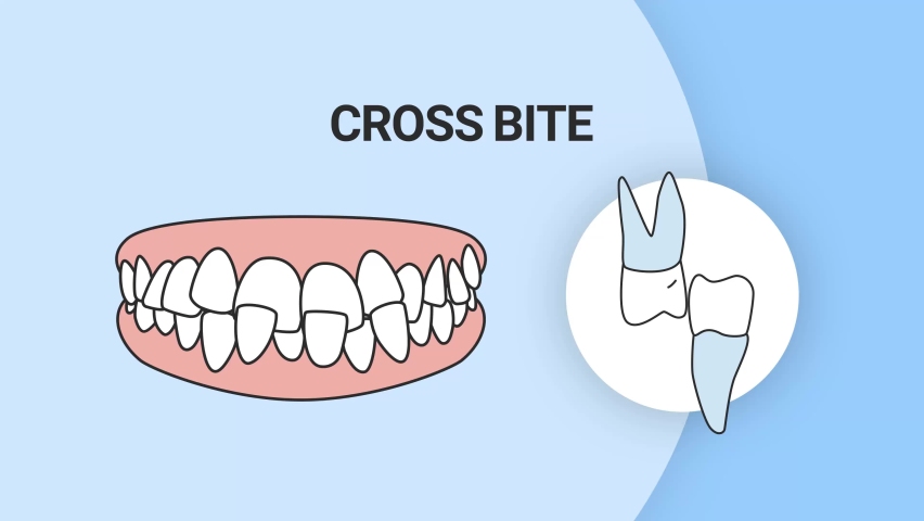Malocclusion Cross Bite. Dental problem. 3d illustration. Dental care concept. | Shutterstock HD Video #1088332513