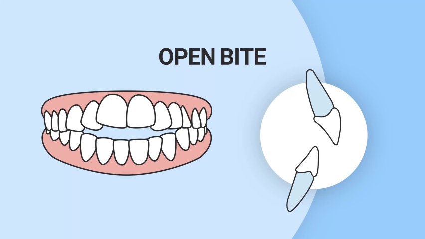 Malocclusion Open Bite. Dental problem. 3d illustration. Dental care concept. | Shutterstock HD Video #1088332515