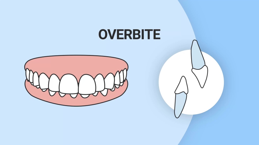 Malocclusion Overbite. Dental problem. 3d illustration. Dental care concept. | Shutterstock HD Video #1088332517