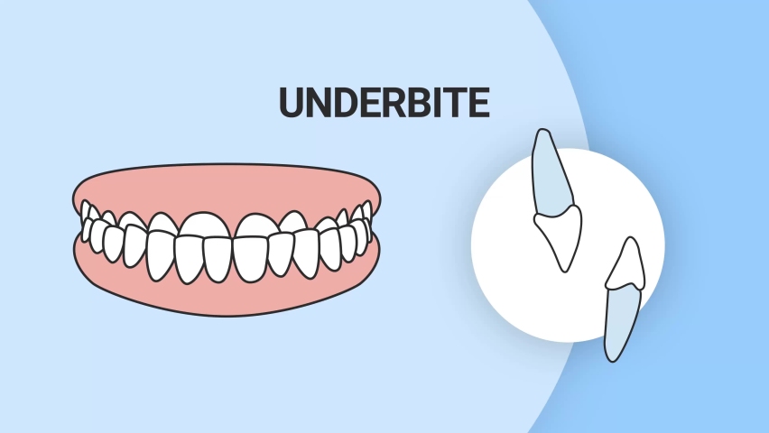 Malocclusion underbite. Dental problem. 3d illustration. Dental care concept. Royalty-Free Stock Footage #1088332521