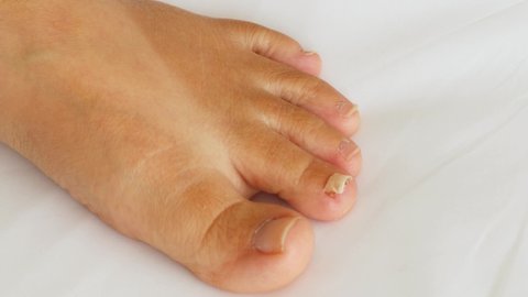 Attempting to remove a partially detached, dead toenail with tweezers