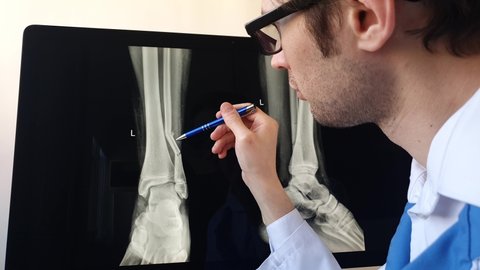 Man radiologist analyzing a football player patient x ray with a fibula fracture.