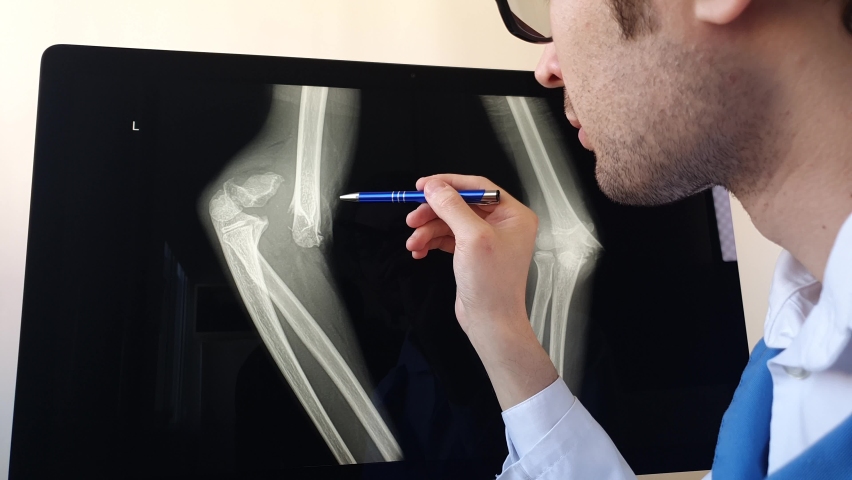 Man radiologist analyzing a patient child elbow bones x ray with a distal humerus fracture with displacement. Royalty-Free Stock Footage #1088498783