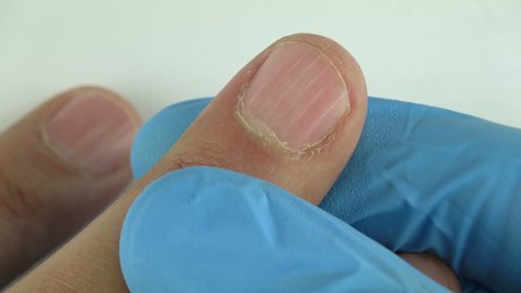 55 White Spots On Finger Nails Stock Video Footage - 4K and HD Video Clips | Shutterstock 55 White Spots On Finger Nails Stock Video Footage - 4K and HD Video Clips | Shutterstock
