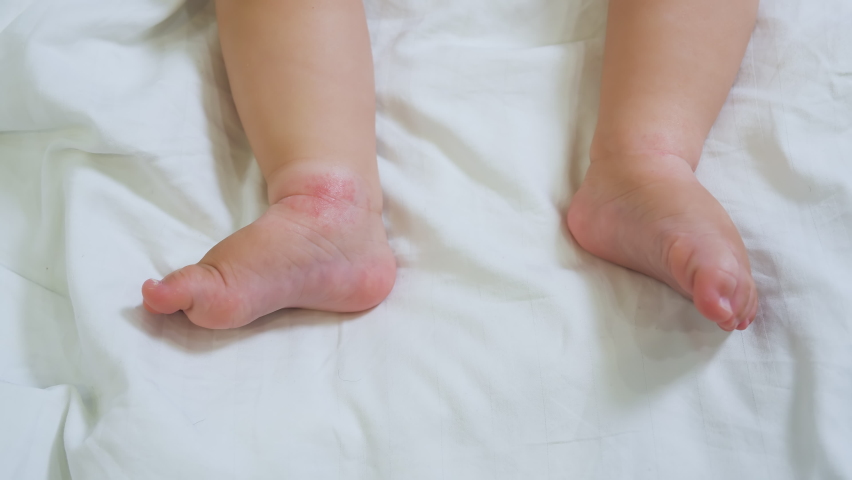Legs of a small child are atopic. Atopic dermatitis of the skin on legs of a newborn baby. Small baby lies on a white sheet for up to a year and rubs his legs. Close-up of reddened legs. Royalty-Free Stock Footage #1088529599