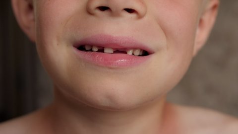 A close-up of a little boy shows his fallen out baby teeth. Change of teeth in children.