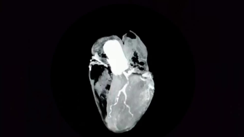 3d beating human heart in radiology scan machine animation, realistic coronary artery medical background in 4k