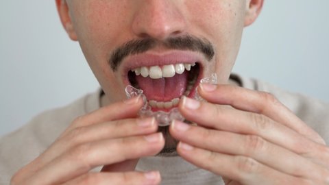 Adult man putting transparent braces for dental correction. Caucasian person holding invisible orthodontic retainer and aligner. Plastic braces dentistry to straighten teeth in dentist office