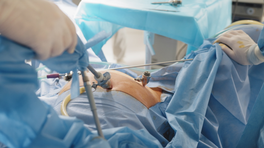 Close up of hands of surgeons team during operation uterus removal with surgical laparoscopy instruments. Gynecology. Team surgeon at work on laparoscopy operating in hospital. Close up. Royalty-Free Stock Footage #1088806311