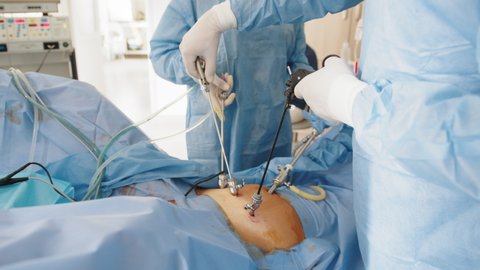 Laparoscopic surgery in hospital. Modern medical equipment in operating room. Surgical intervention in abdominal cavity for treatment or elimination of pathology, careful precise movements of doctor.