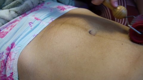 A postpartum doula makes a massage on the belly of a woman after childbirth with a roller with needles. Scar healing after caesarean section.