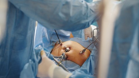 The surgeon's doing laparoscopic surgery in the operating room. Minimally invasive surgery. Surgeons team hands during laparoscopic abdominal operationOperation using laparoscopic equipment