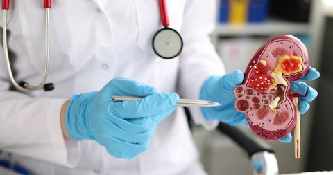 Doctor urologist holds model of kidney closeup