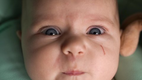 Close-up of a baby's face. The frowning child looks into the camera with large, wide eyes. Scratch on the cheek. Light eyebrows, black eyelashes, nose. Glare in the eyes. Day. Flat. Static camera