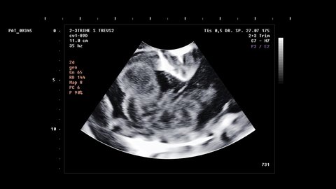 Pregnancy Ultrasound Scan Investigates Infant In Belly. Pregnancy Confirmed By Ultrasound Scan Device. Pregnancy Screening Ultrasound Scan. Prenatal Testing. Medical Examination. Childbirth