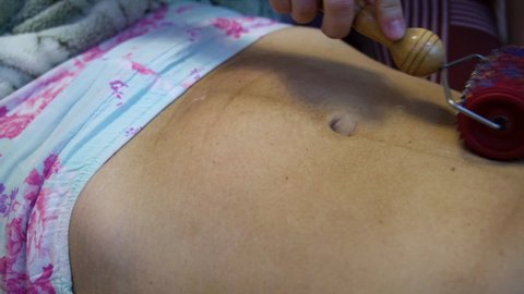 A postpartum doula makes a massage on the belly of a woman after childbirth with a roller with needles. Scar healing after caesarean section.