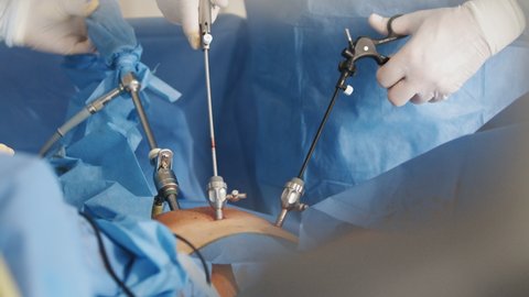 Operation using laparoscopic equipment. The surgeon's doing laparoscopic surgery in the operating room. Minimally invasive surgery. Surgeons team hands during laparoscopic abdominal operation