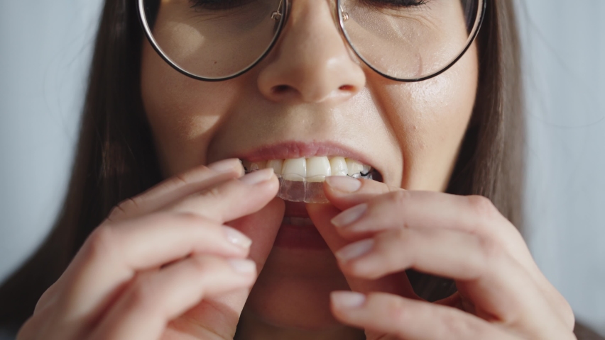 Close-Up View On Smile Young Woman With Invisalign Braces Sitting Alone In Home Smiling Looking At Camera. People And Style Concept. Clear And Removable Aligner Retainer Or Tooth Whitening System | Shutterstock HD Video #1089058267