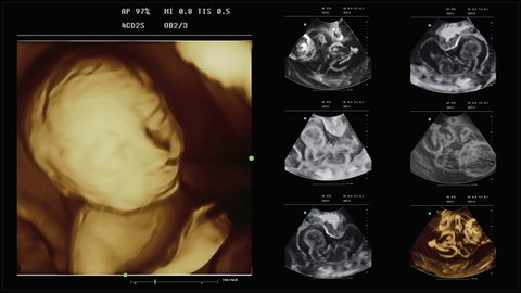 Examination Of Baby Health In Interface For Ultrasound Analysis. Using Scanner To Identify Possible Baby Birth Defects. Child Health Examination. Baby Health Examination By Pregnancy Monitoring System