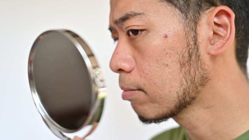 Worried Asian man saw the problem of pimple or acne occur on his face by a mini mirror. Conceptual shot of Acne and problem skin on male face. | Shutterstock HD Video #1089378555