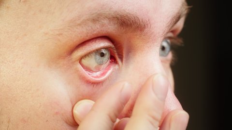 Close-up of a blue-eyed young man putting on contact lens with fingers and blinking. Advertising of contact lenses for vision improvement. Optical shop, health care and medicine concept.