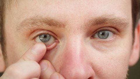 Close-up of a blue-eyed young man taking off contact lens with fingers and blinking. Advertising of contact lenses for vision improvement. Optical shop, health care and medicine concept.