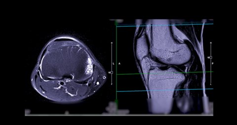 MRI Knee  joint or magnetic resonance imaging of the knee  for diagnosis sport trauma and damage of ligaments anterior cruciate ligament (ACL).