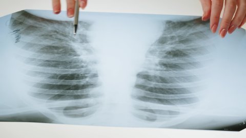 Lungs x-ray close-up. Doctor examining ribs roentgen, human chest. Healthcare and medicine concept, checkup.