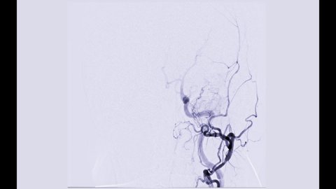 Cerebral angiography  from Fluoroscopy in intervention radiology  showing cerebral artery for diagnosis cerebral artery aneurysm.