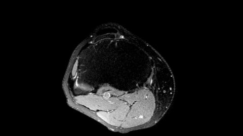 MRI knee joint. Dynamics of scrolling through MRI images. Magnetic resonance imaging of right knee - view from above. Diagnosis sport trauma and damage of ligaments.