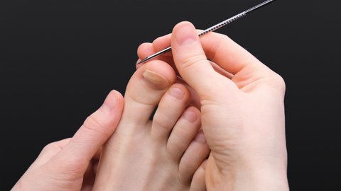 Big toe nail injury. Doctor-podolog removes dead nails. A runner with a professional injury. Cracked toenail. Isolated leg with a broken nail. A podiatrist works with a diseased nail.