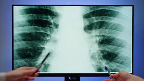 Healthcare and medicine. Doctors examining lungs x-ray close-up. Nurse and therapist looking at ribs roentgen on computer monitor, human chest, checkup. 