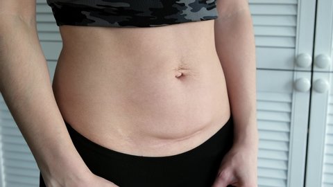 Abdomen of woman after the child birth by Cesarean section. Scar on the skin. Stretch marks after pregnancy. Excess overweight. Ugly hernia of navel. Diastasis of an abdomen white line. Close-up.