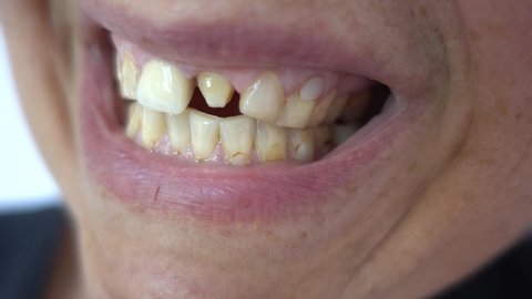 4K Bared teeth of mature woman with one broken, extreme close up
