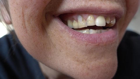 4K Bad tooth condition in smiling female mouth with one crown

