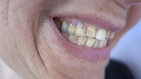 4K Evil grin of mature woman with problemed teeth, close up
