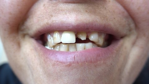 4K Close up Smiling mouth with chewing-gum and one tooth crown
