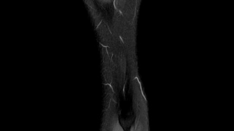 Dynamic scrolling through MRI images of knee joint. Diagnosis sport trauma and damage of ligaments. Magnetic resonance imaging of right knee.