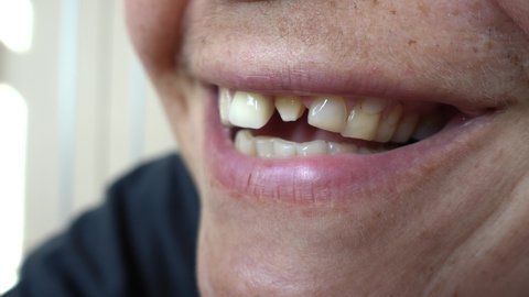 4K Side view on smiling mouth with one tooth crown and one stub
