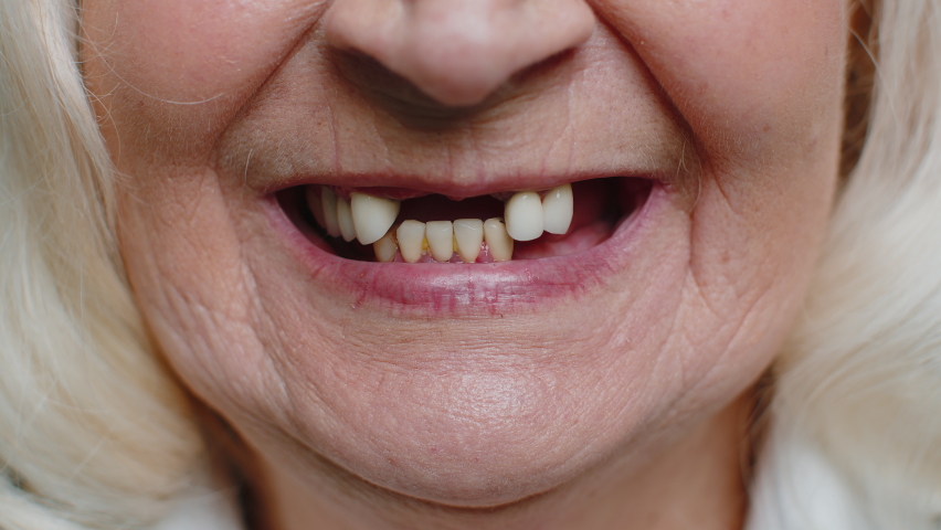Close-up macro shot of toothless female smile mouth of senior elderly woman. Dental problem, bad teeth loss. Pensioner lady showing his rotten teeth, caries, decayed and weak enamel, teeth falling out | Shutterstock HD Video #1090382021